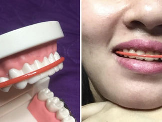 Thailook Braces Tiada Bukti Keberkesanan