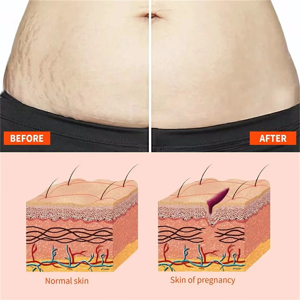 Thumbnail: BumpGlow™ Stretch Mark Prevention Oil