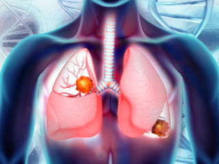 Agilent Receives MFDS Approval in South Korea for Companion Diagnostic PD-L1 IHC 22C3 pharmDx