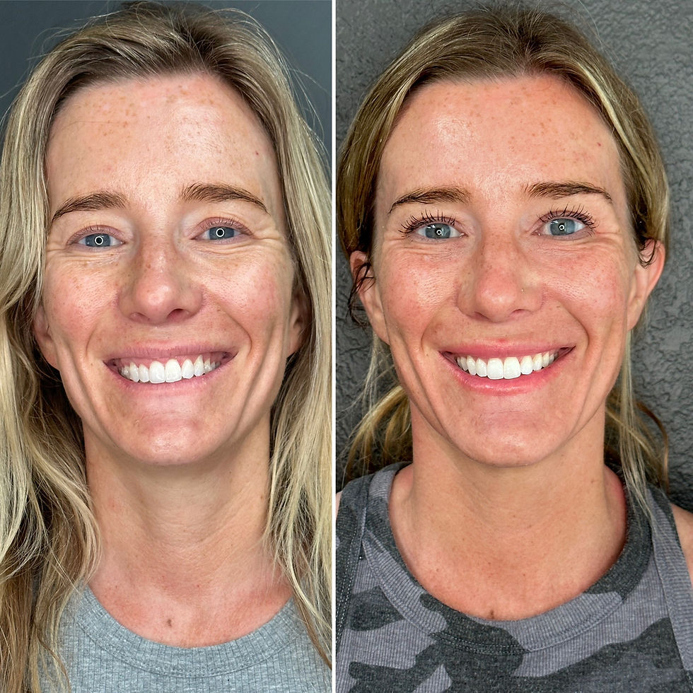 What to Expect with a Personalized Dermal Filler Treatment Plan in Denver and Aurora