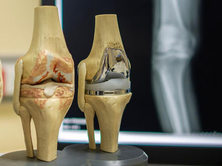 Revizyon Diz Protezi: İlk Ameliyattan Farkı Nedir?