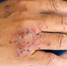 Allergic contact dermatitis is a form of dermatitis/eczema caused by an allergic reaction to a material, called an allergen, in contact with the skin. The allergen is harmless to people that are not allergic to it.  Allergic contact dermatitis is also called contact allergy.