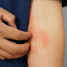 Eczema is a skin condition that causes dry and itchy patches of skin. It’s a common condition that isn’t contagious. Symptoms of eczema can flare up if you contact an irritant or an allergen.