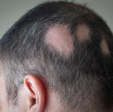 Alopecia areata is an autoimmune disease that attacks your body’s hair follicles, causing patchy hair loss. Medications and therapies can help your hair regrow, though severe cases may not respond to treatment.