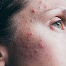 Acne vulgaris is the formation of comedones, papules, pustules, nodules, and/or cysts as a result of obstruction and inflammation of pilosebaceous units (hair follicles and their accompanying sebaceous gland). Acne develops on the face and upper trunk.