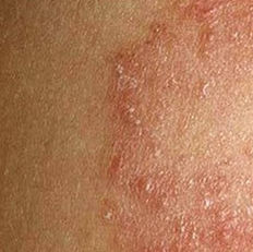 Ringworm of the body (tinea corporis) is a rash caused by a fungal infection. It's usually an itchy, circular rash with clearer skin in the middle. Ringworm gets its name because of its appearance.