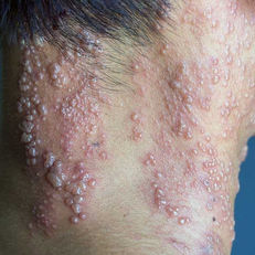 Shingles (herpes zoster) is a viral infection that causes an outbreak of a painful rash or blisters on the skin. It's caused by the varicella-zoster virus, which is the same virus that causes chickenpox. The rash most often appears as a band of rashes or blisters in one area of your body.