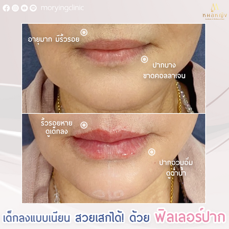 650227_fillerปาก_คุณ.png