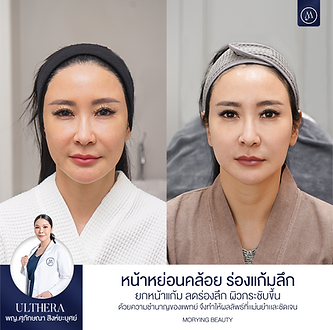 670818_BA_Ulthera_ACM2825-L22 สุชญาดา(คุณแอ้).png