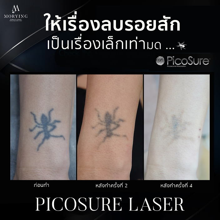Picosure รอยสักมด.png