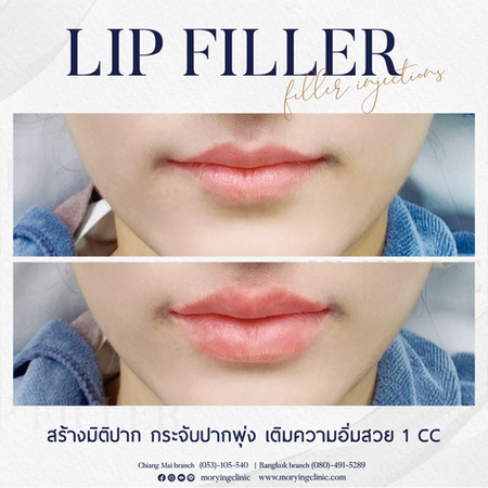 650421_fillerปาก_คุณผู้หญิง.png