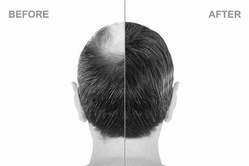 HAIR TRANSPLANT SURGERY 