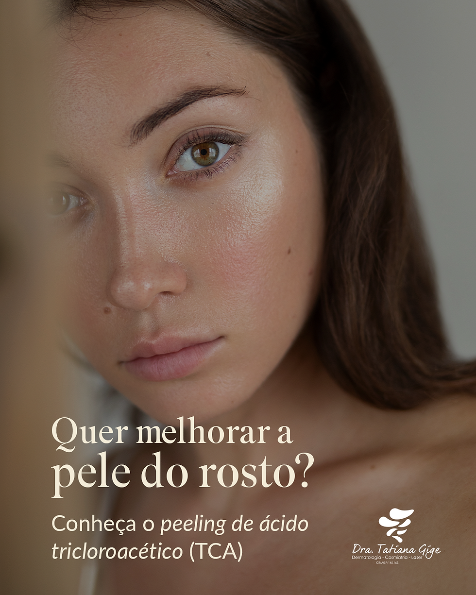 Quer melhorar a pele do rosto? Conheça o peeling de ácido tricloroacético (TCA)