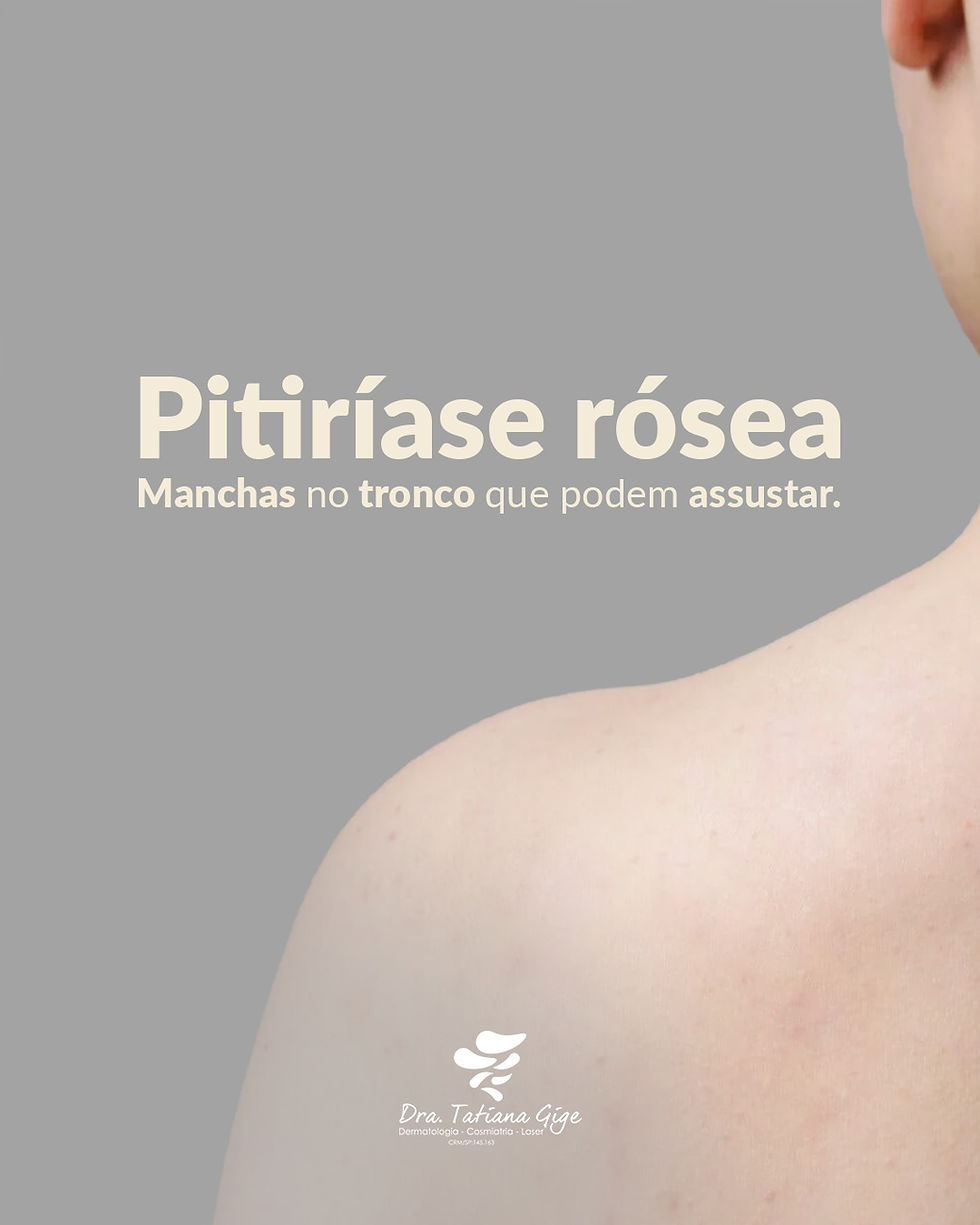 Pitiríase rósea - Manchas no tronco que podem assustar.