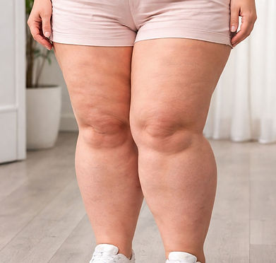 lipedema