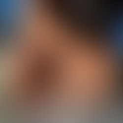 Você SABIA? Suor excessivo pode ser tratado com botox.