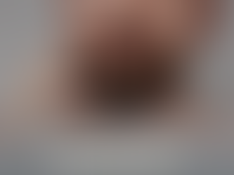 Inflamações na barba: saiba mais sobre pseudofoliculite.