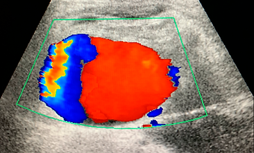 FOTO US PSEUDOANEURISMA