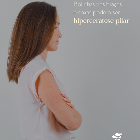 Bolinhas nos braços e coxas podem ser hiperceratose pilar