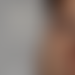 RUGAS PROFUNDAS E PERDA DE VOLUME FACIAL: como o ácido hialurônico atua na recuperação da estrutura da pela.