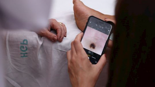 Exames para detectar câncer de pele caem pela metade durante pandemia