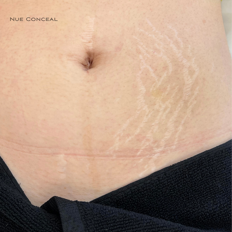 Healing Beyond the Surface: Inkless Stretch Mark Revision That Works