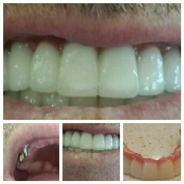 İmplant ve Zirkonyum