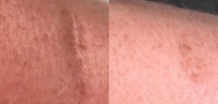 Indented scar.png