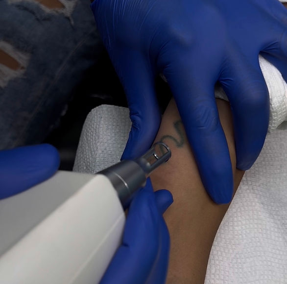 Tattoo Removal