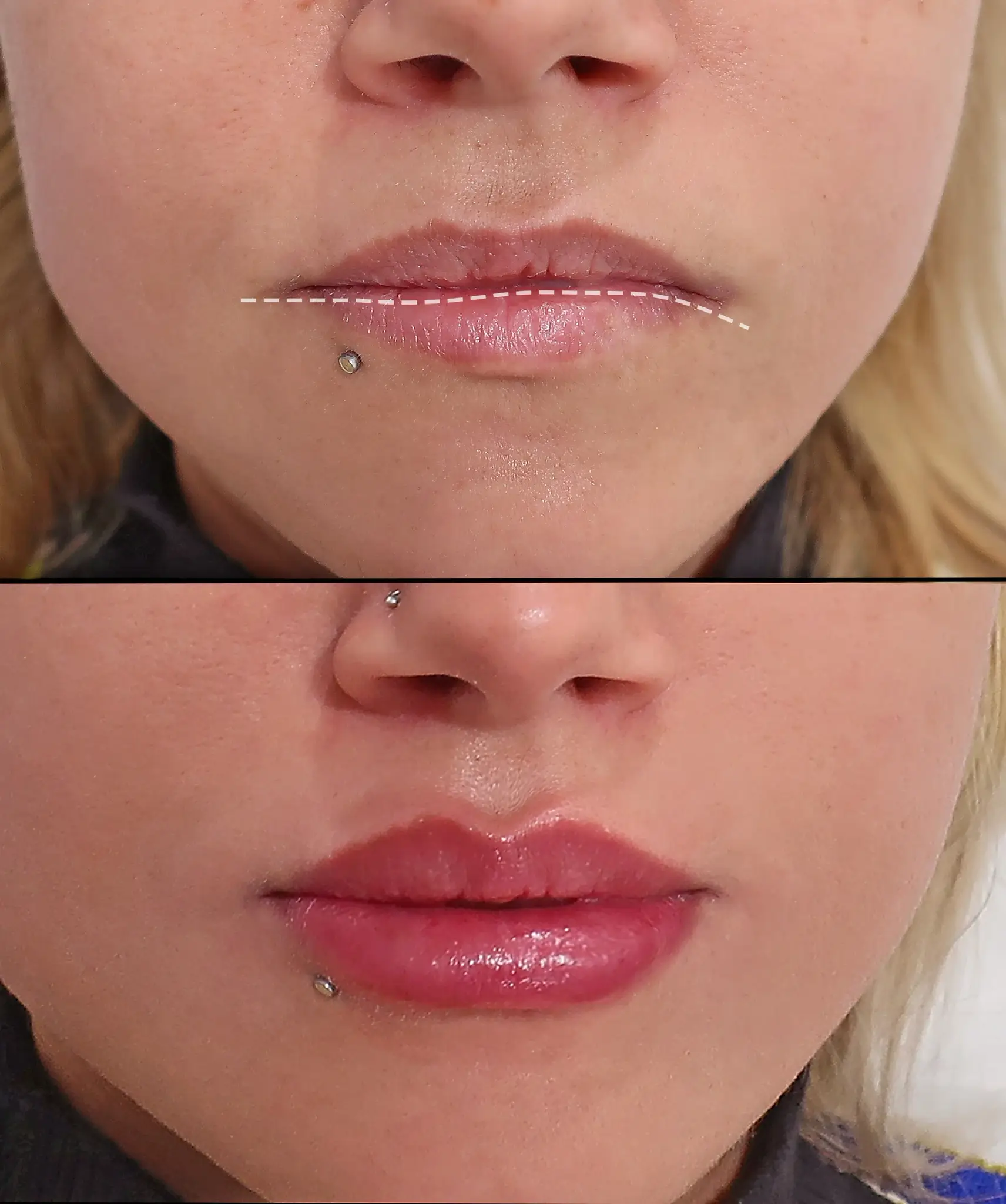 the improved lips line after the lip fillers treatment