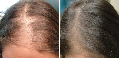alopecia in women before and after result