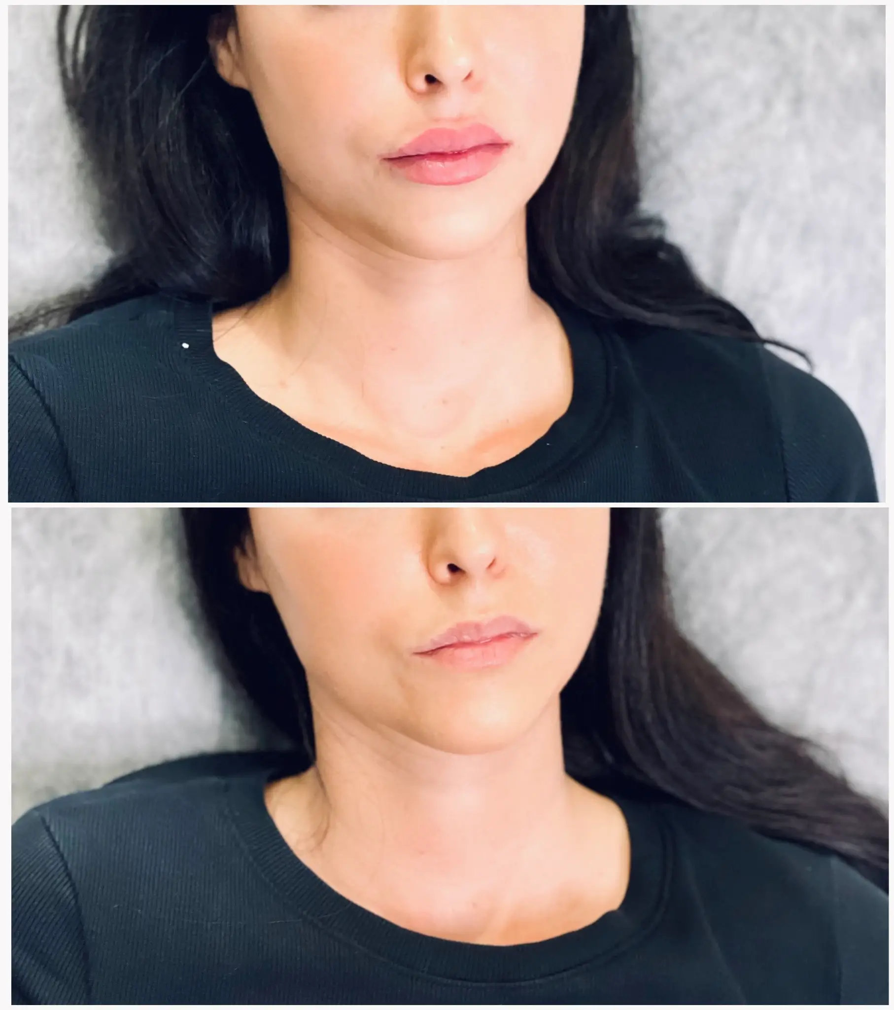 young woman before and after the lip filler treatment