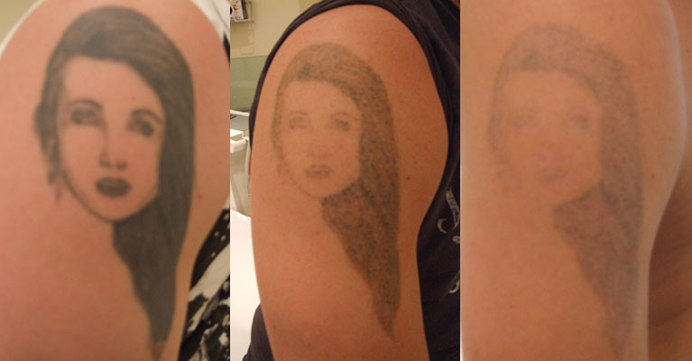 laser tattoo removal of large tattoo at skinoza clinic before and after results