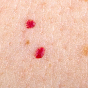 Cherry Angiomas on man or woman skin