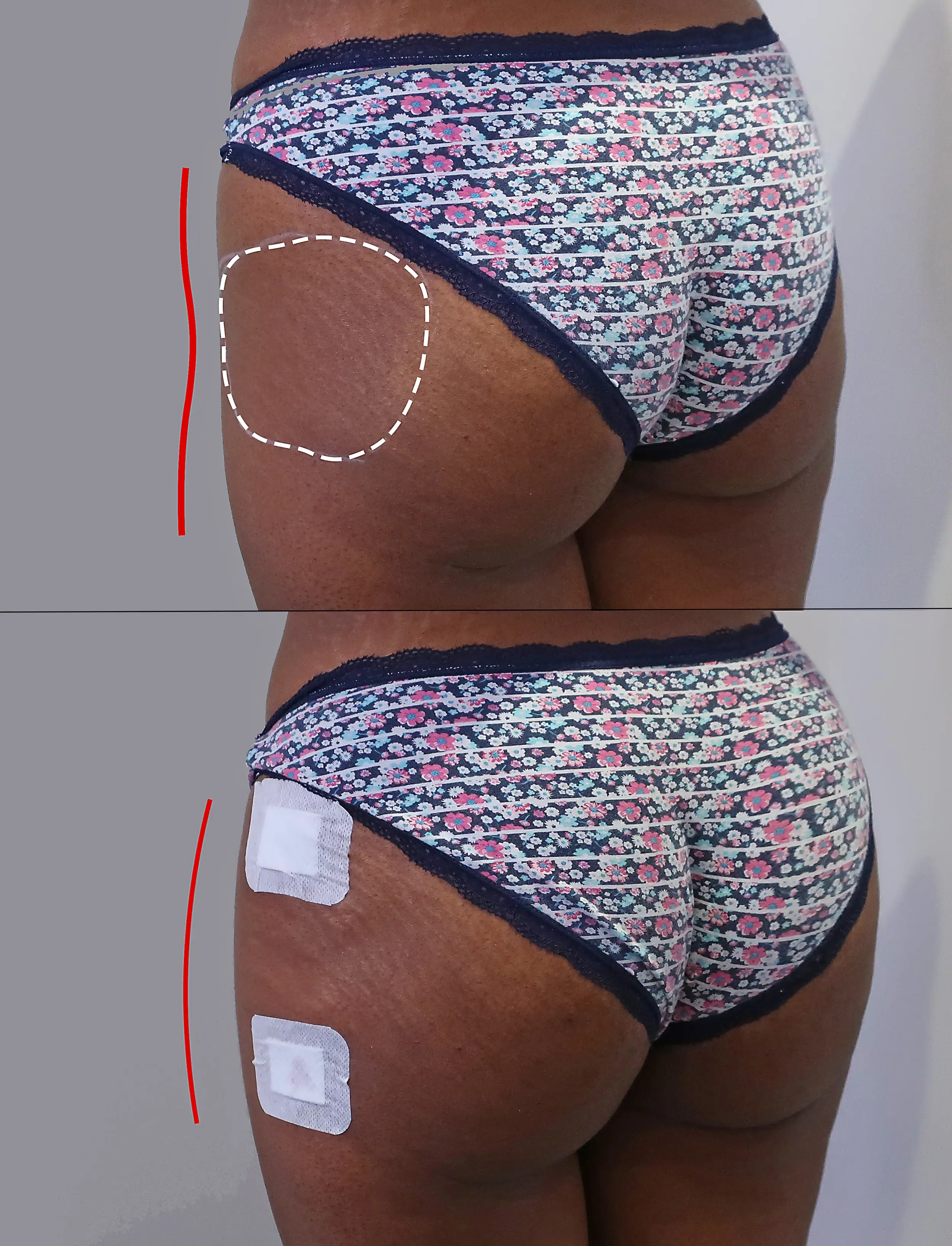 sculptra butt lift results in dark skinned woman