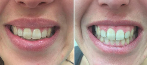 Gummy_smile_botox_before_after