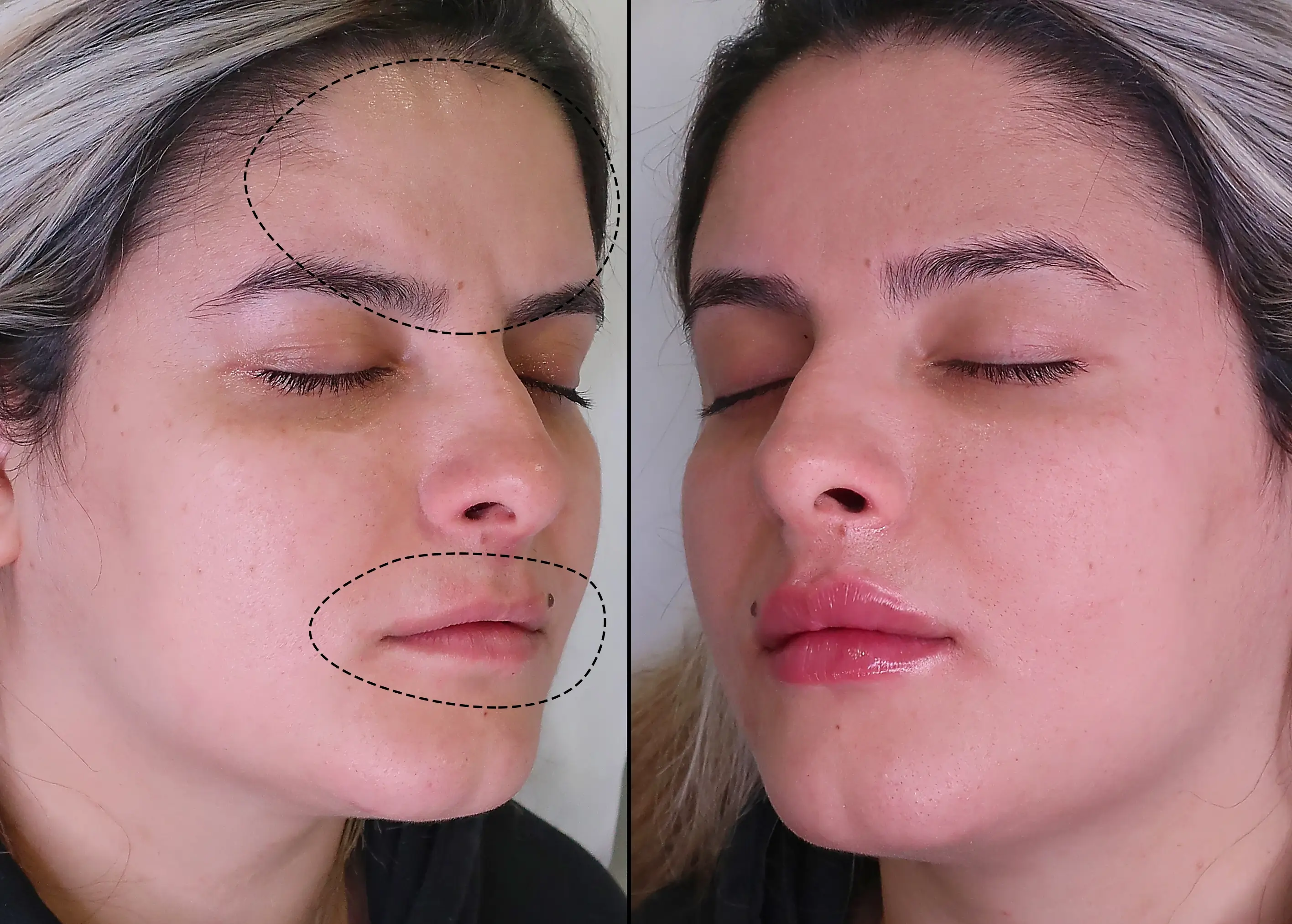 young woman before and after the lips augmentation and botox on frown lines