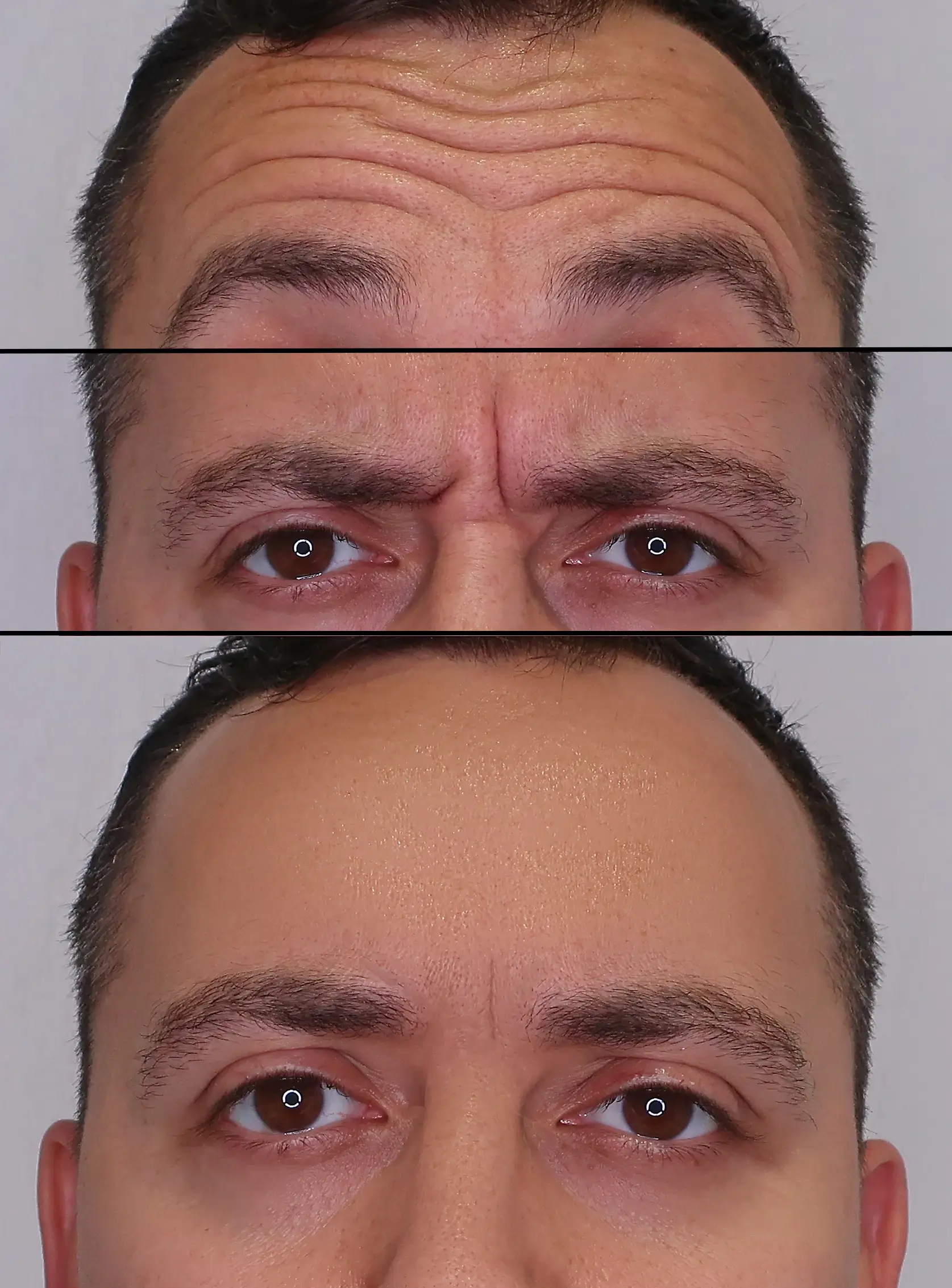 young man before and after the botox treatment on his forehead