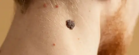 Close up young man with mole on neck