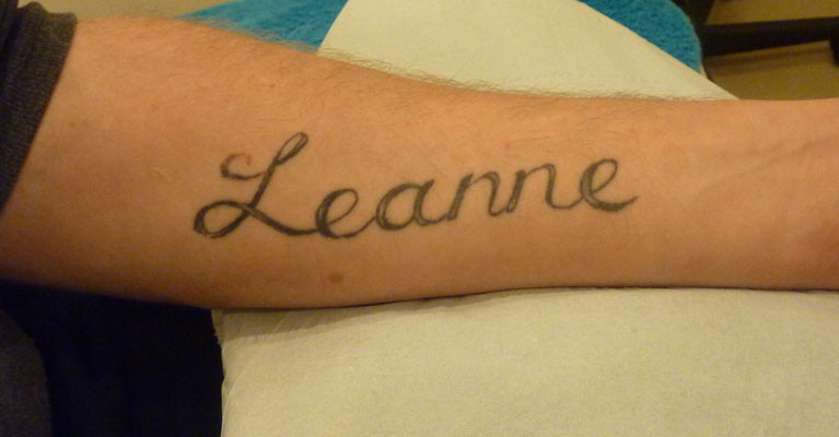 male hand with tattoo before tattoo removal