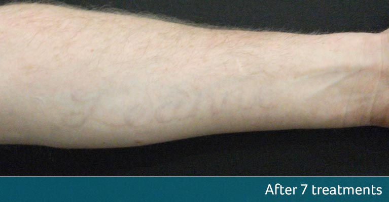 male hand after tattoo removal result