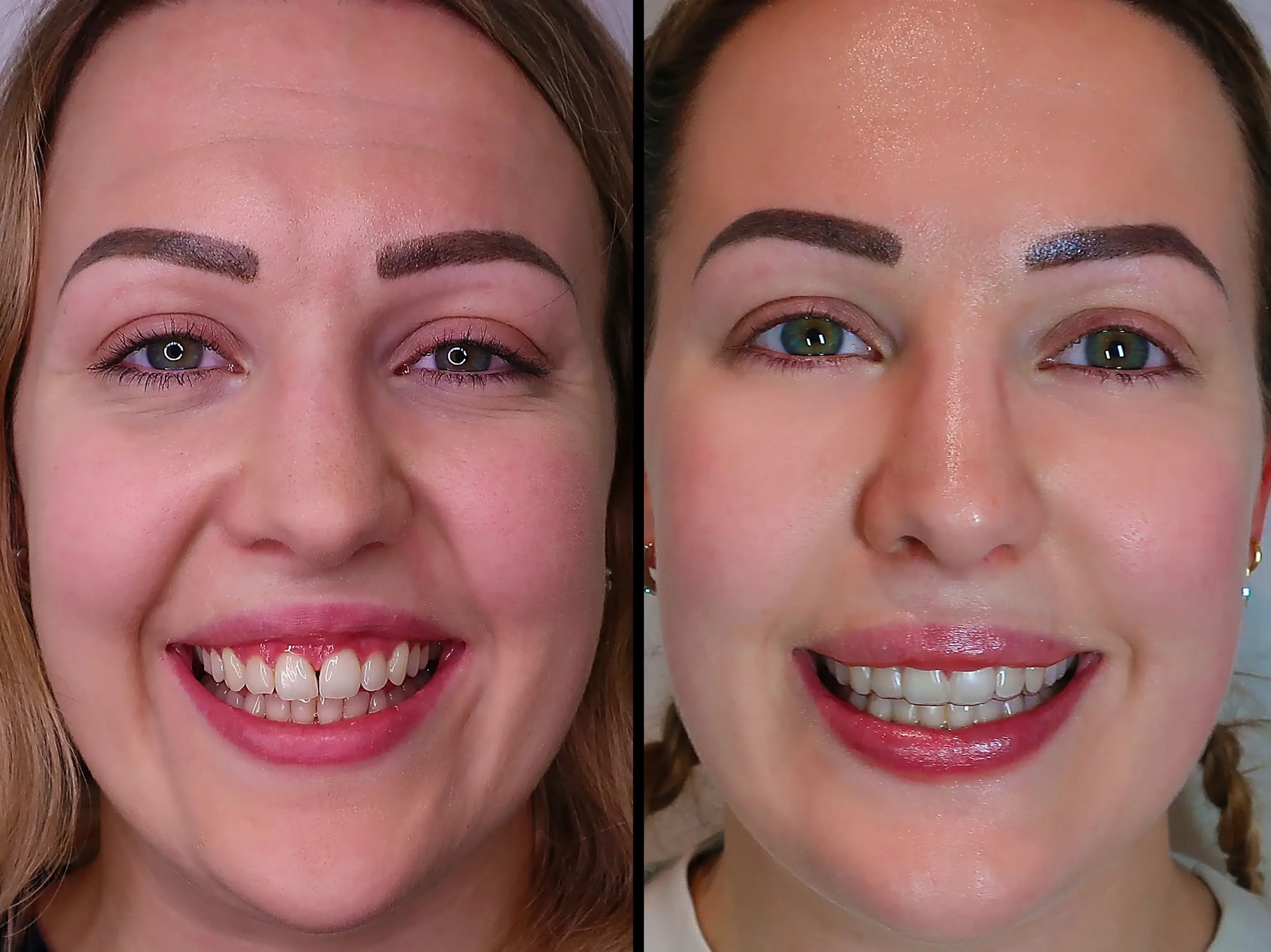 female patient before and after the botox for gummy smile treatment at skinoza clinic