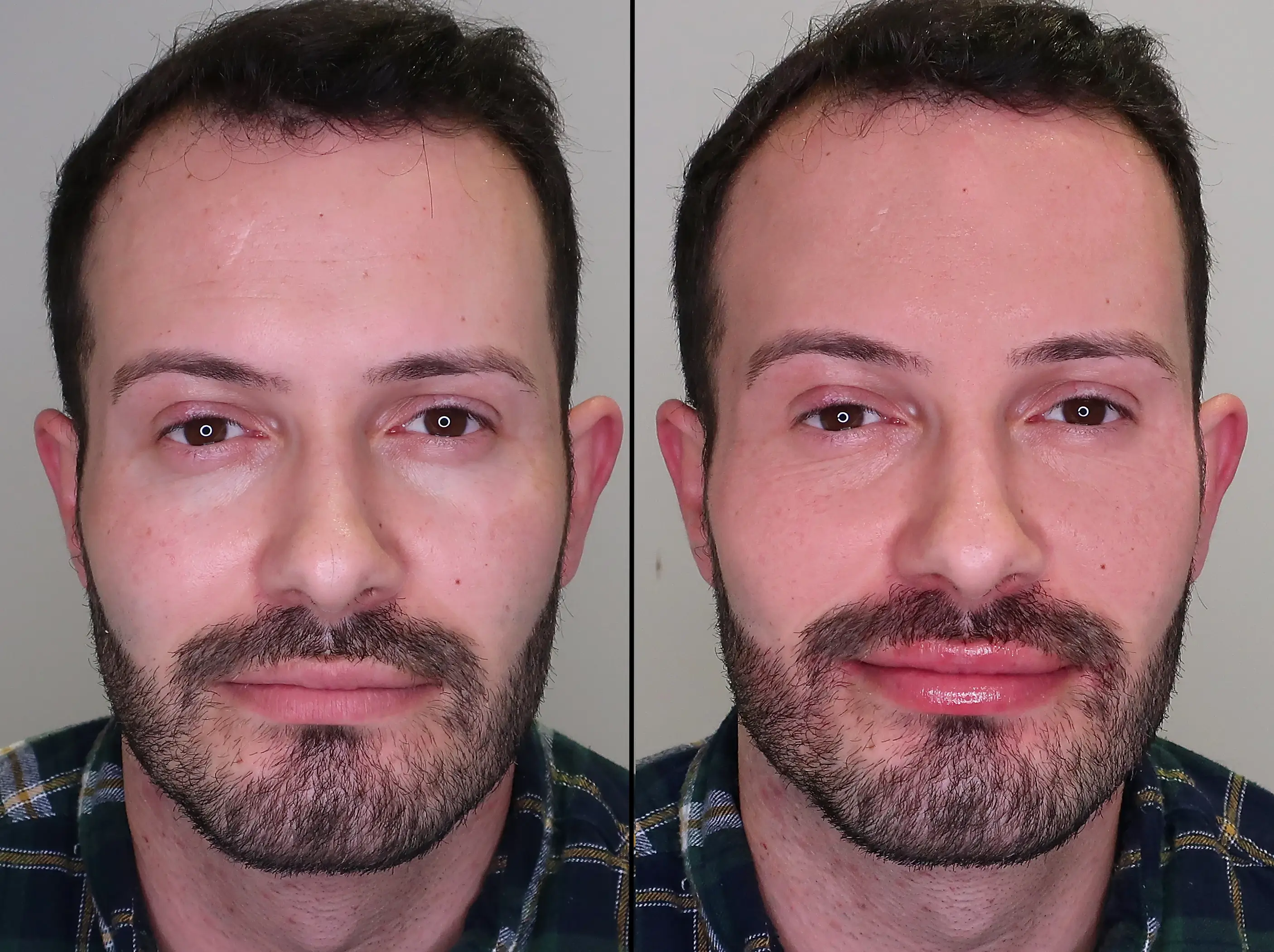 before and after the dermal fillers treatment for men