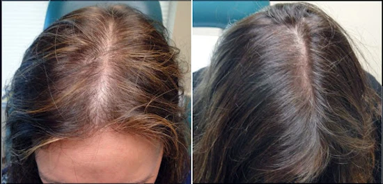 hair loss in women before and after result
