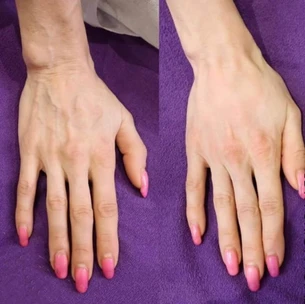 results after dermal filler for hands on a female hand
