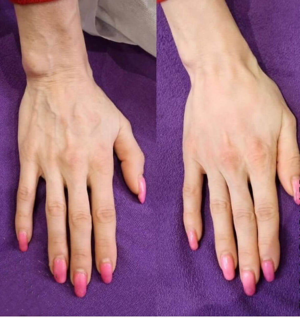 results after dermal filler for hands on a female hand
