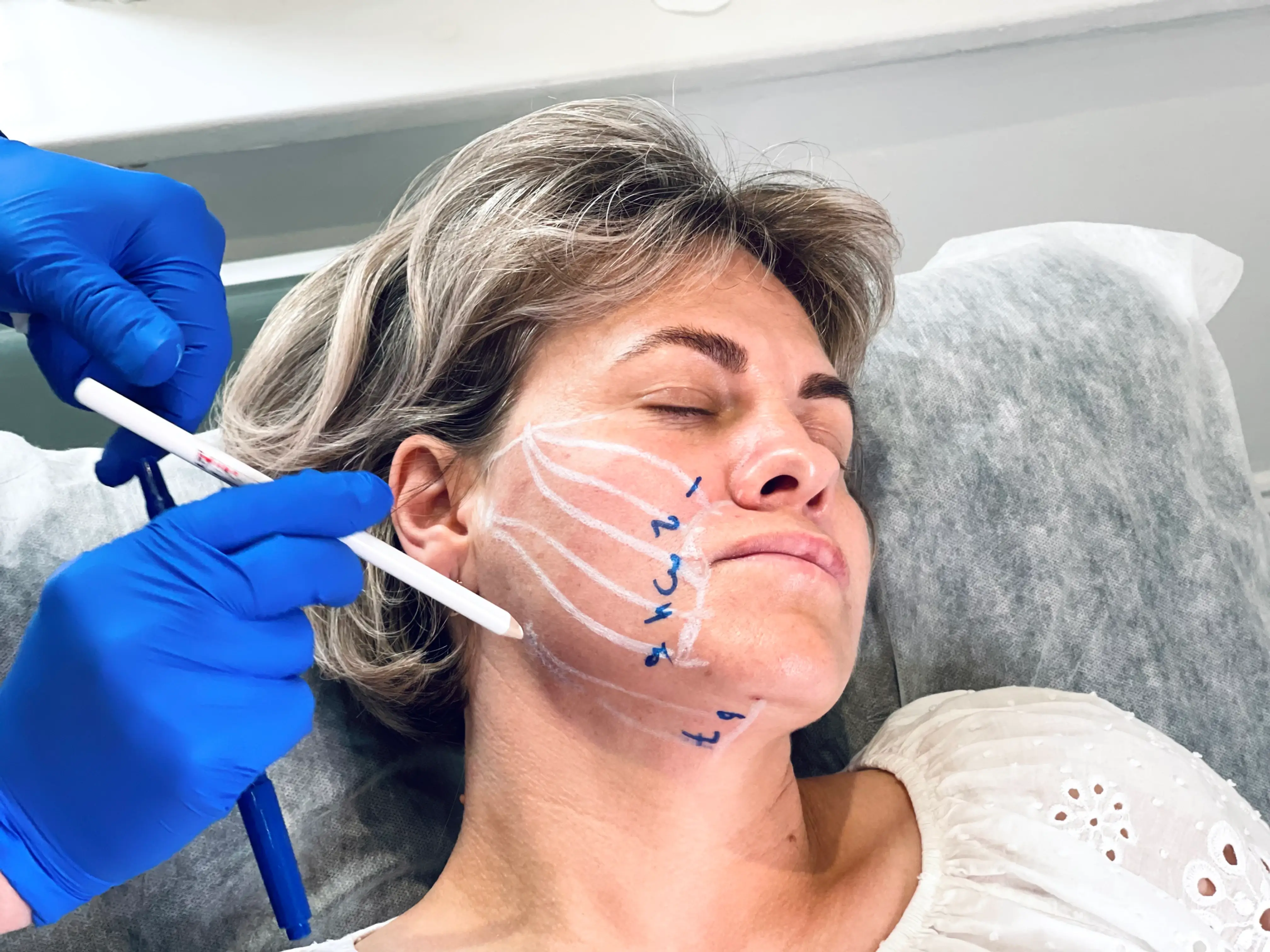 adult woman with white lines on the face before the face thread lift treatment