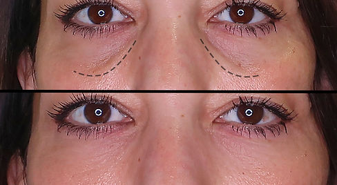Tear trough filller before and after