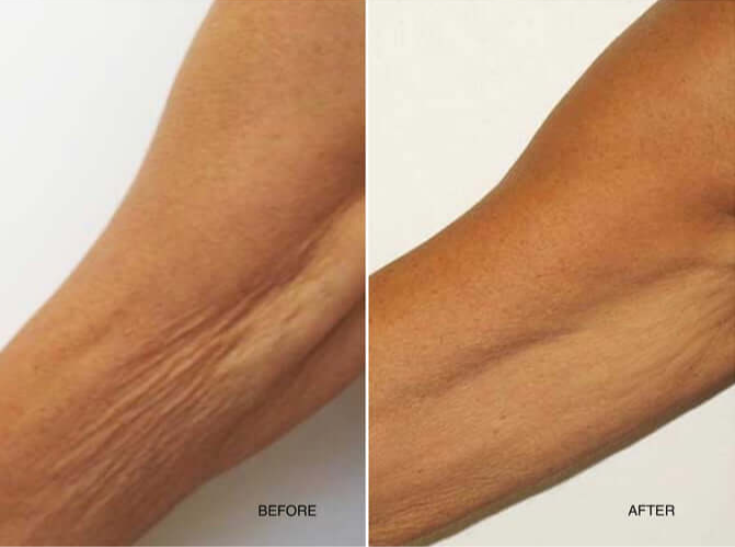 Before and After PROFHILO treatment for skin laxity in the arms