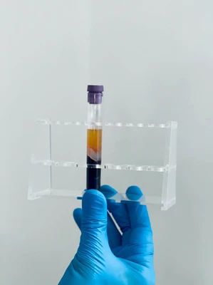 plasma separated from blood sample for prp for hair at skinoza clinic